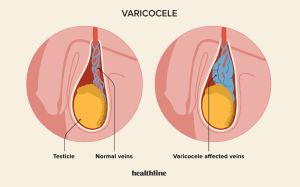 varicocele testicular
